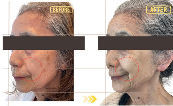 症例2 ビフォーアフター